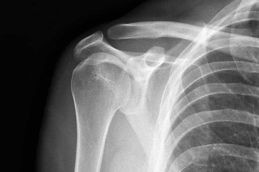Câncer ósseo: Saiba em que momento é preciso procurar um médico
