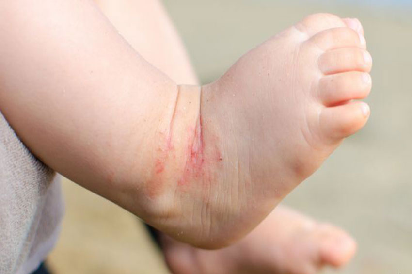 Você sabe o que é Dermatite Atópica?