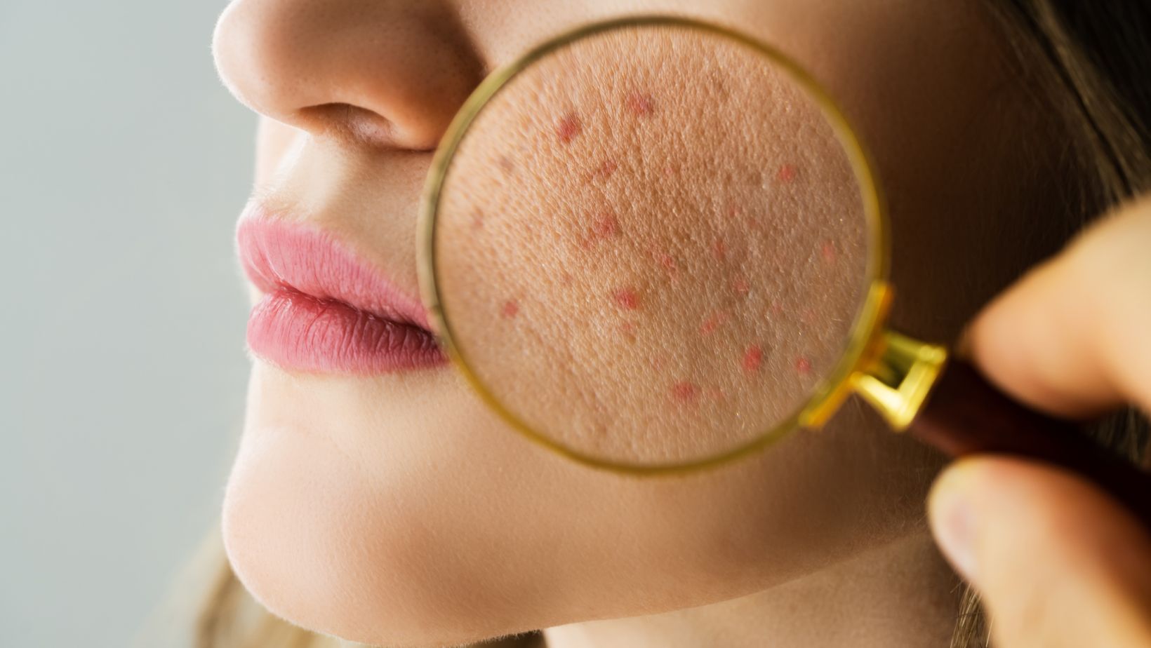 O que você come pode estar te causando acne! Descubra quais são esses alimentos e o que fazer para se prevenir da acne