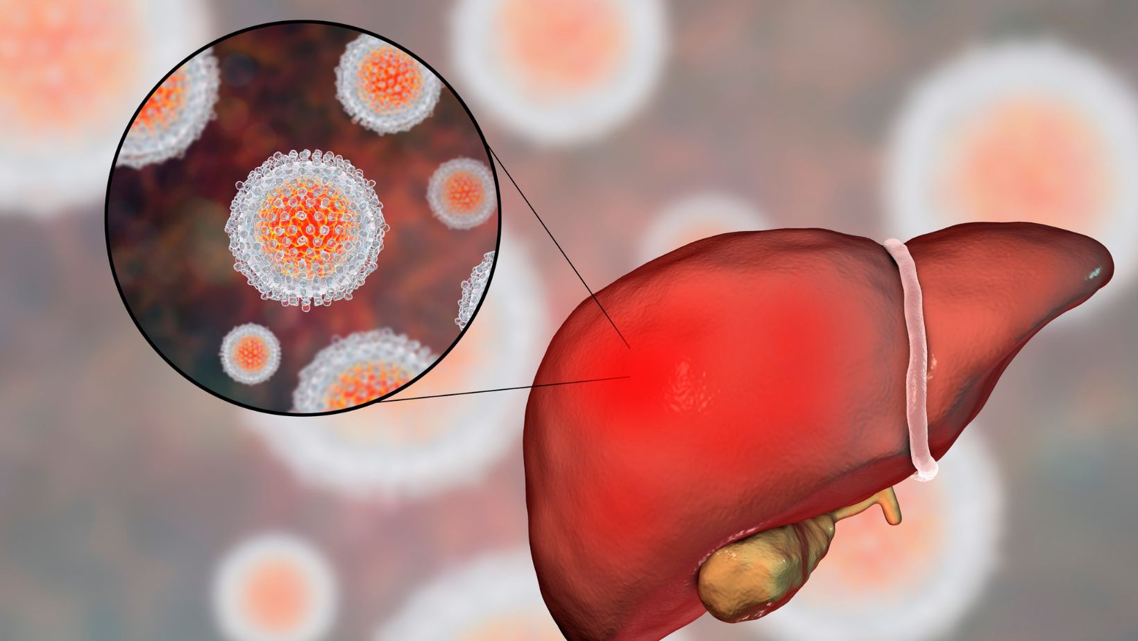 Sintomas e riscos das Hepatites A e B: O que fazer para se proteger?