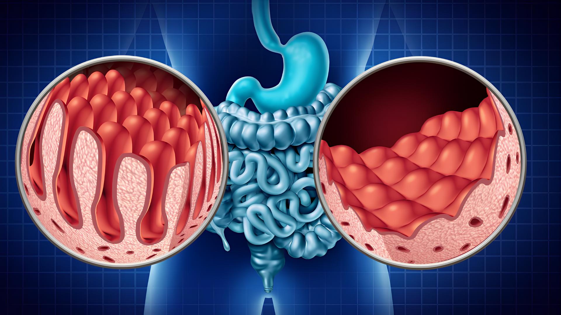 Artigo - Doença celíaca na ciência médica moderna: conceitos e abordagens atuais