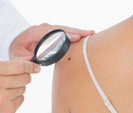 Uma pinta e o diagnóstico do mais agressivo e letal, câncer de pele: o melanoma  