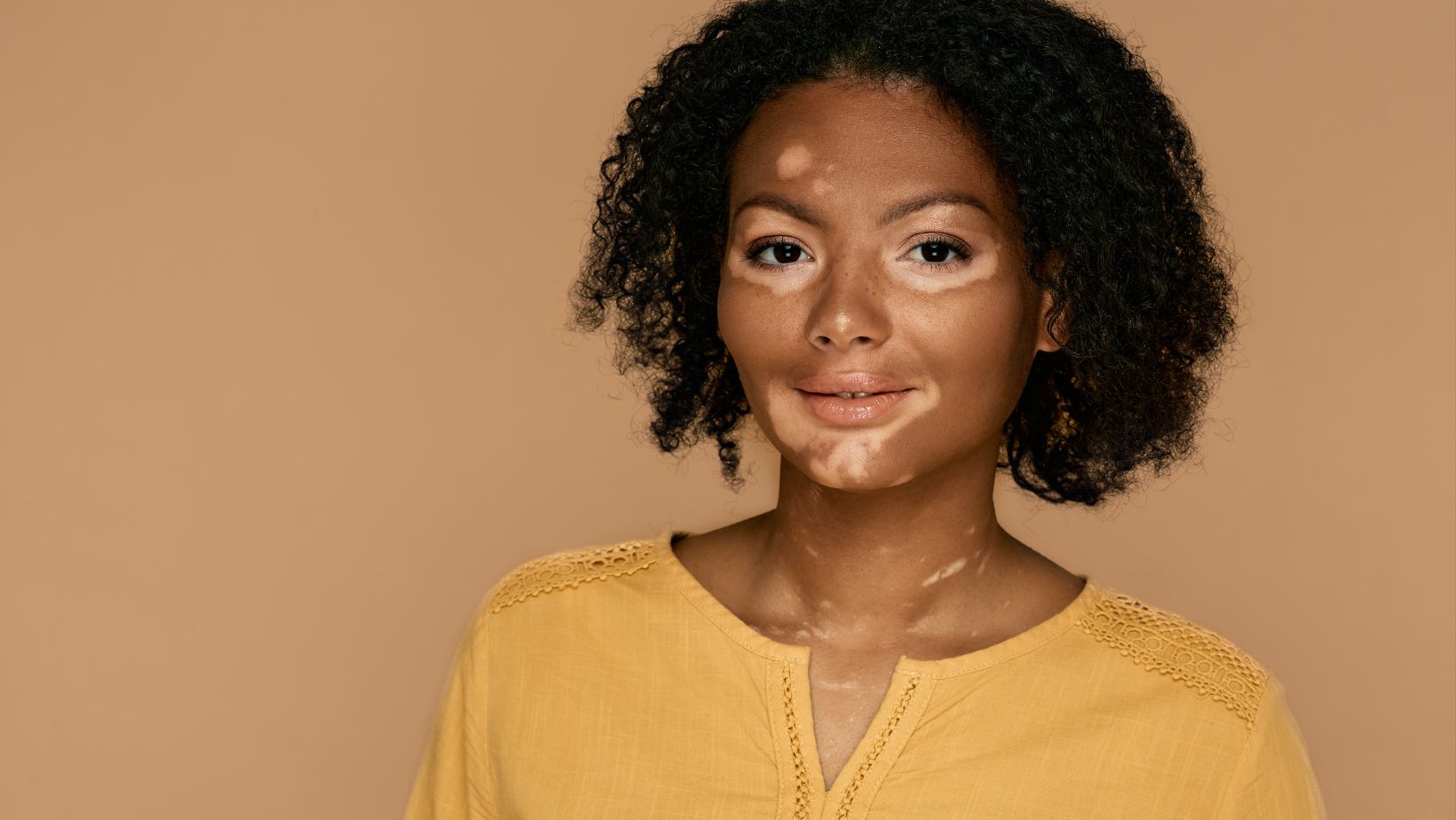 Mês do Vitiligo; saiba o que é a doença que causa manchas brancas na pele