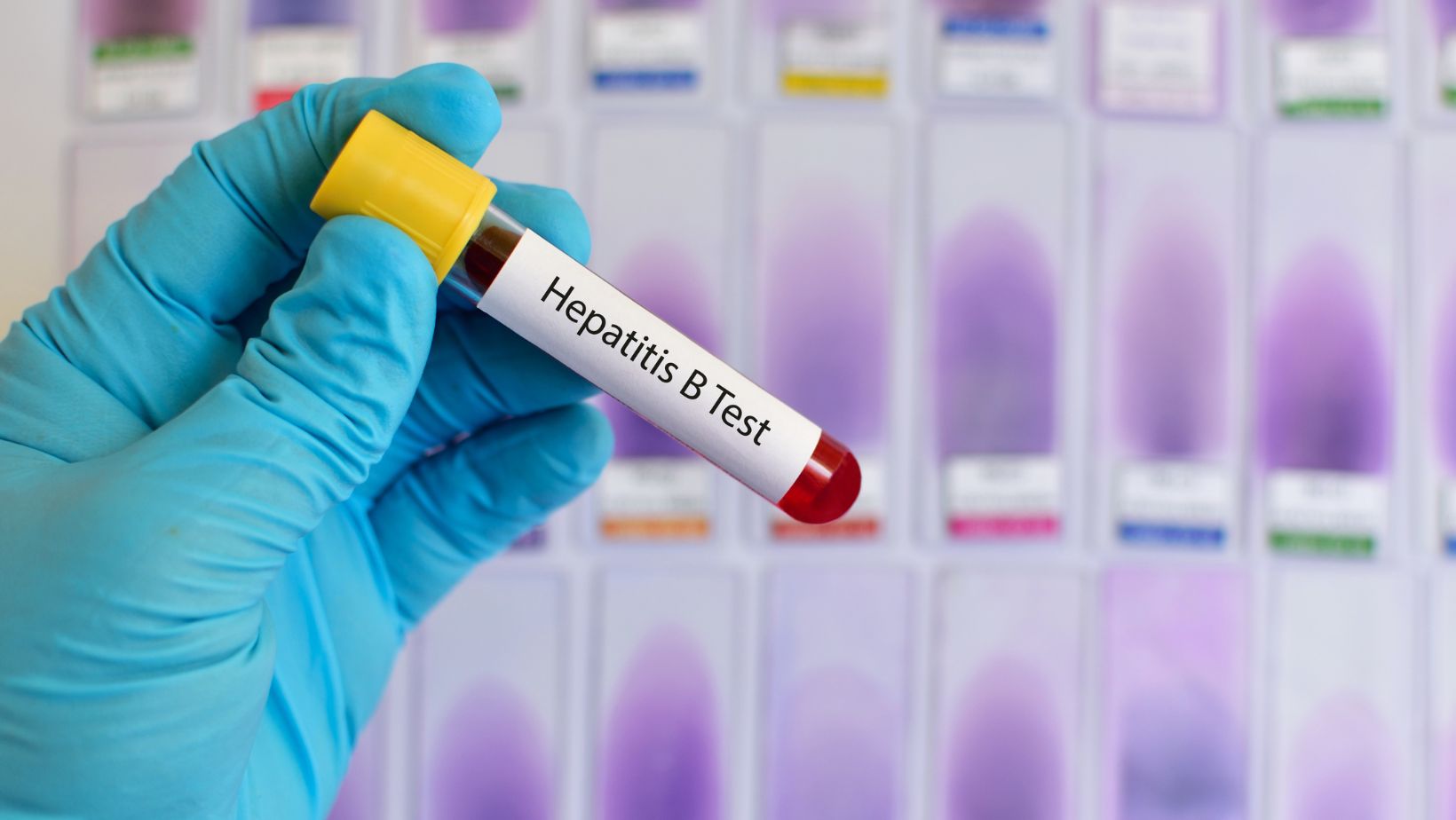 Julho Amarelo: Principais causas, sintomas e tratamento da Hepatite B