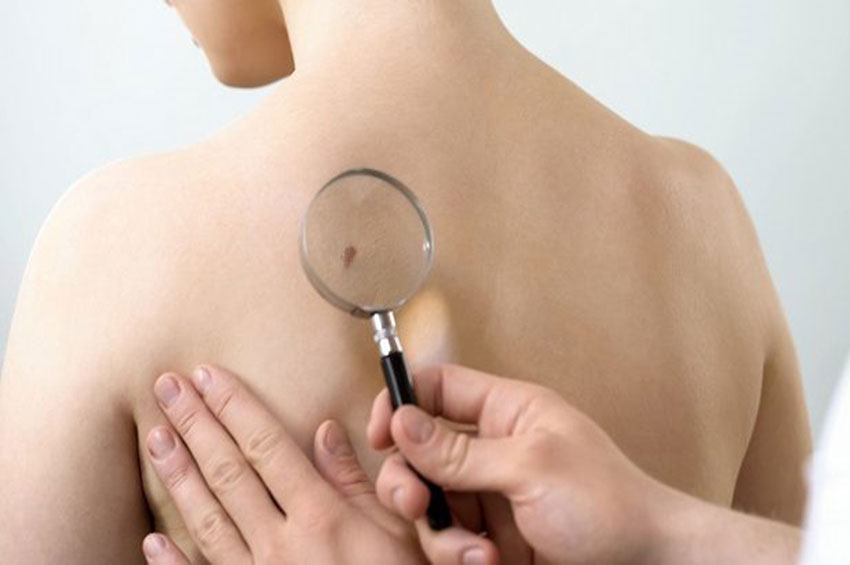 Incidência de câncer de pele é maior em homens
