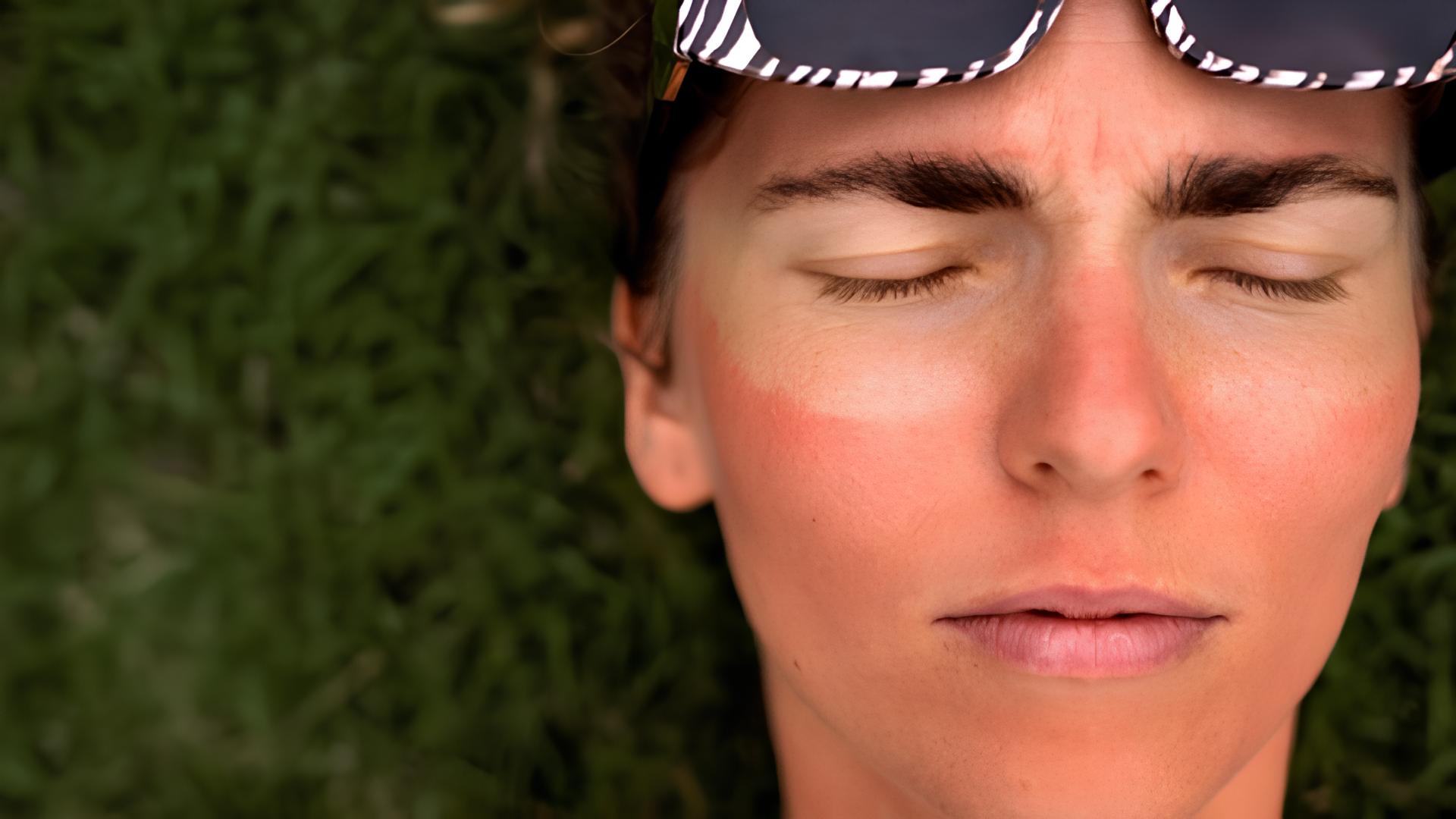 Manchas após as férias: como recuperar a pele depois do excesso de sol