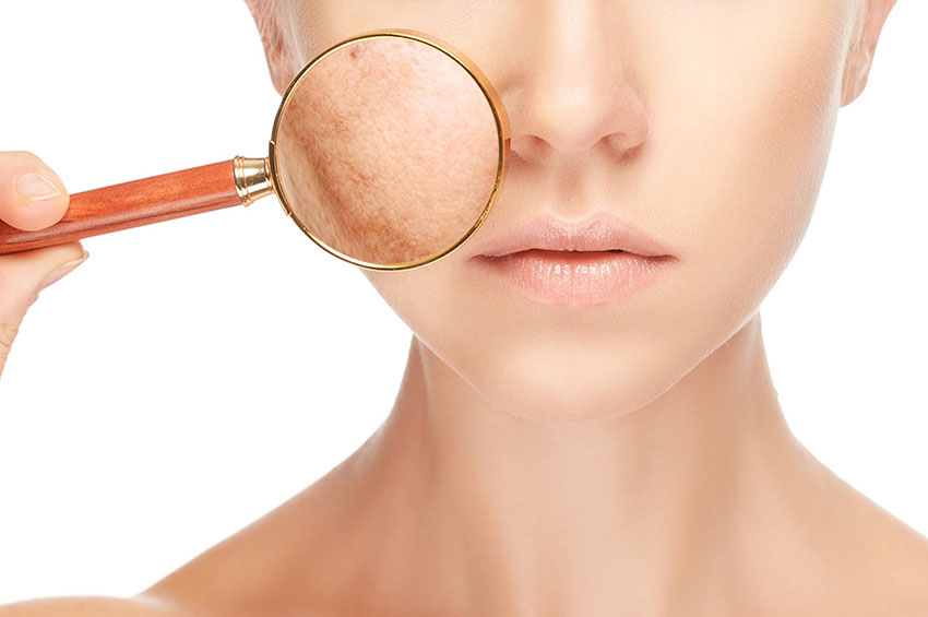  Melasma: Entenda as causas e como prevenir essas manchas na pele 
