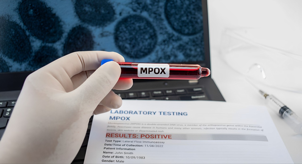 OMS declara emergência de saúde global devido a surto de mpox na África
