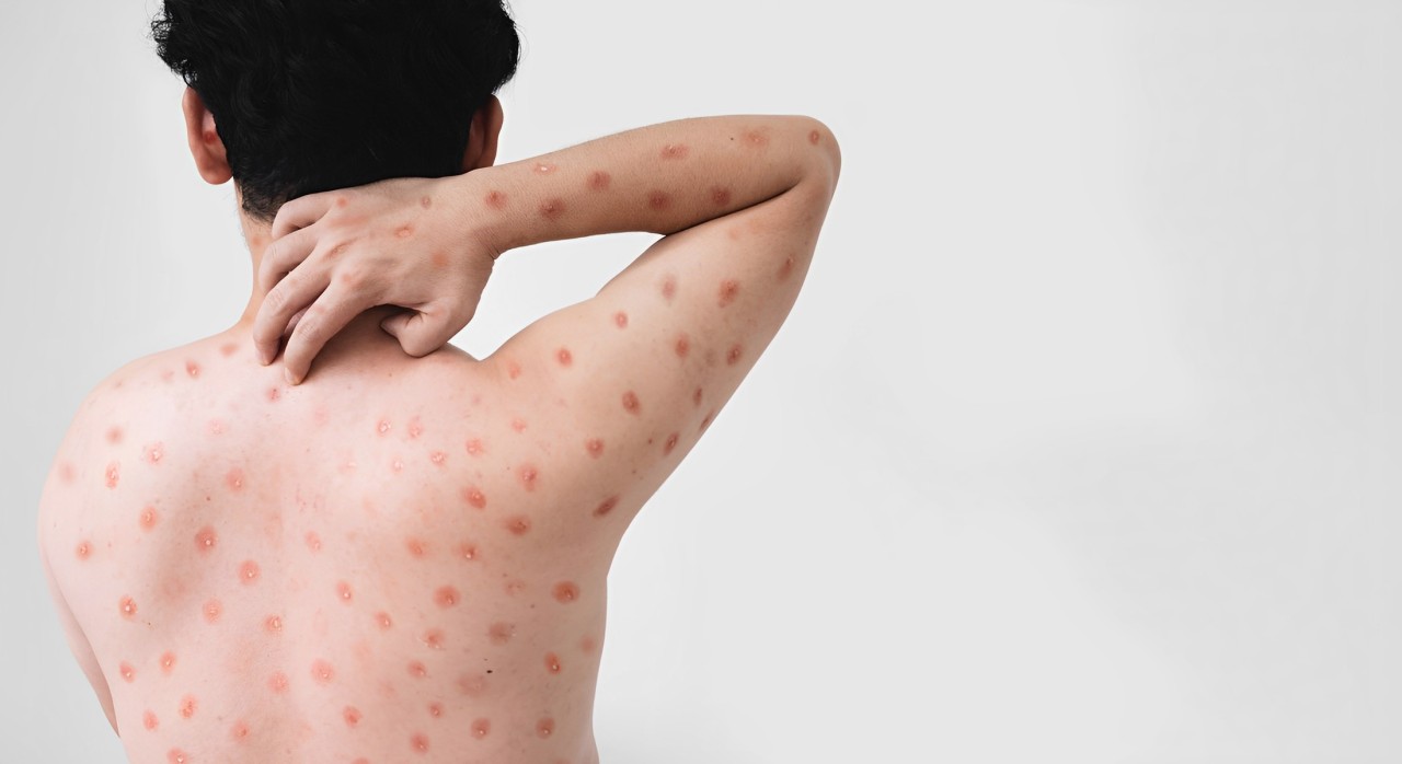 MPox: sintomas, prevenção, tratamento e tudo que você deve saber sobre nova emergência global
