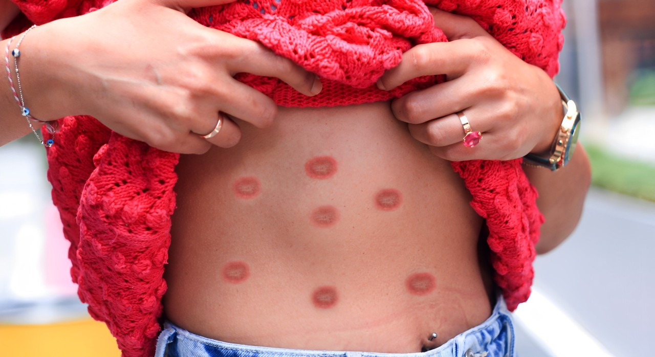 Mpox: Dermatologista explica os principais sintomas na pele e esclarece dúvidas sobre as lesões cutâneas