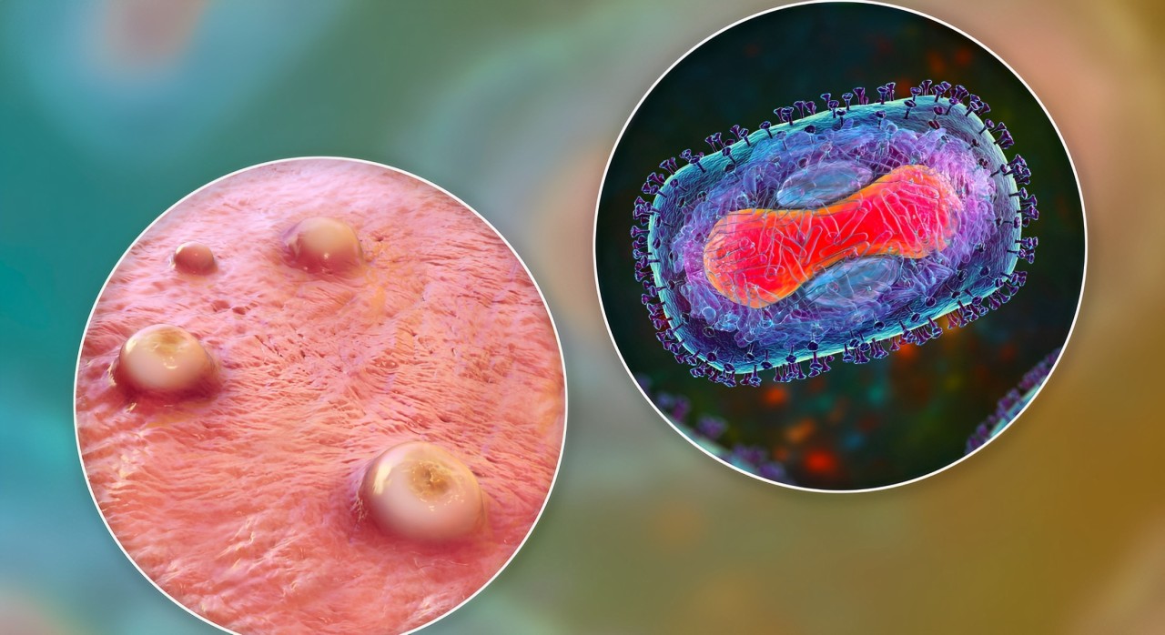 Nova cepa de mpox é detectada no Reino Unido e preocupa autoridades de saúde pública