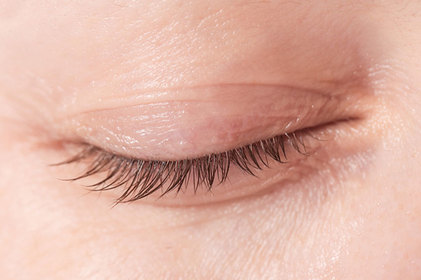 Alergia ocular e tempo seco