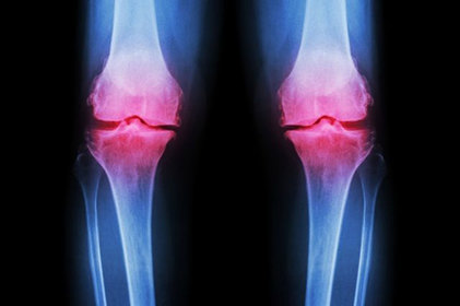 Estudo revela a alta global de osteoartrite em 113.25%