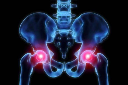 Como identificar a artrose do quadril? Ortopedista explica