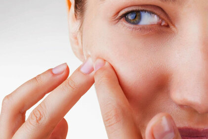 Cicatriz de acne: Como prevenir ou tratar? 