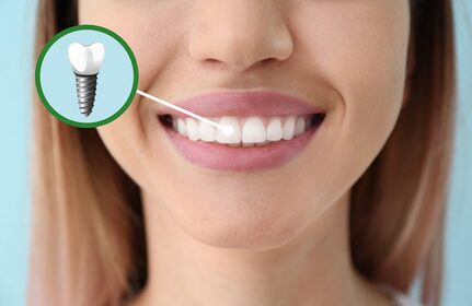 Veja 4 fatores que devem ser levados em conta ao colocar implantes dentários