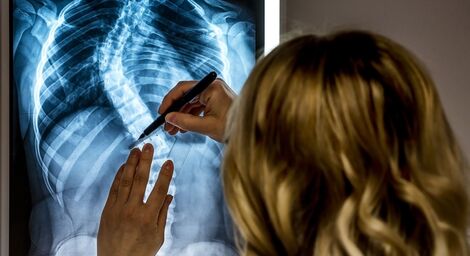 Junho verde: qual a importância do diagnóstico precoce da escoliose?