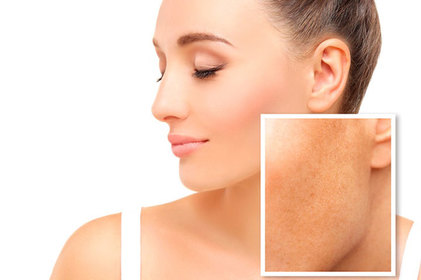 Melasma pode piorar durante o Verão